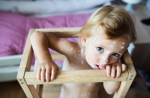 Liten flicka med vattkoppor, sitter i trä stol — Stockfoto