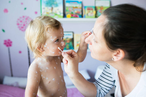 Girl with chickenpox, antiseptic cream applied to the rash
