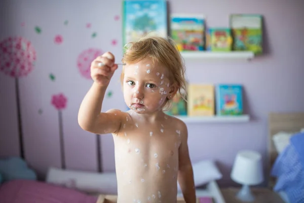 小女孩用水痘，适用于皮疹的抗菌乳膏 — 图库照片
