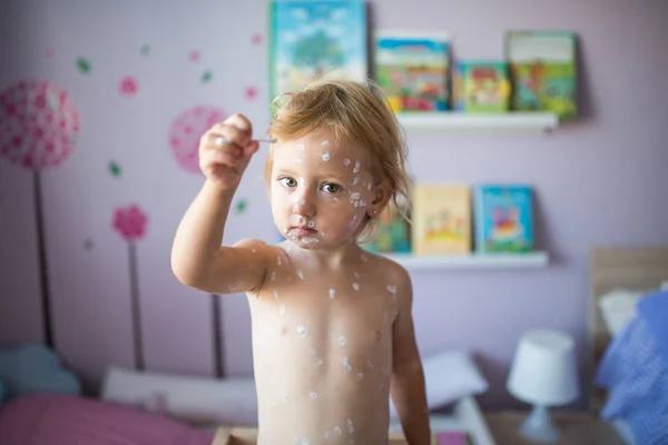 Petite fille avec varicelle, crème antiseptique appliquée à l'éruption cutanée — Photo