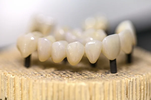Ponte in ceramica dentale — Foto Stock