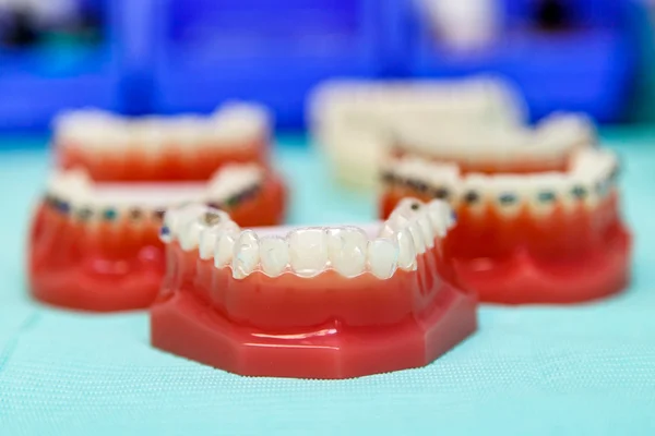 Ortodontyczne niewiem i drutu szelki — Zdjęcie stockowe