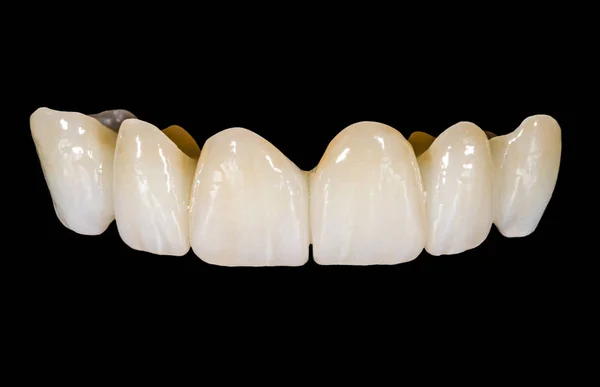 Ponte in ceramica dentale — Foto Stock