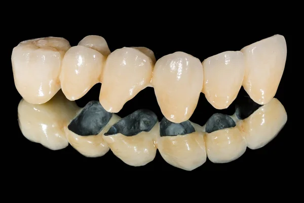Zahnkeramische Brücke — Stockfoto