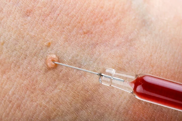 Wrat injectie behandeling — Stockfoto