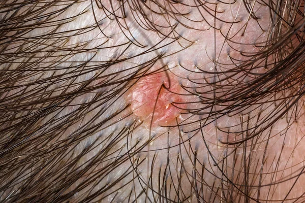 Nevus sebaceus pada kulit kepala — Stok Foto