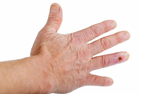 Cicatriz postoperatoria en el cuarto dedo — Foto de Stock