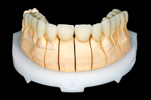 Dental ceramic bridge — Stock Photo, Image