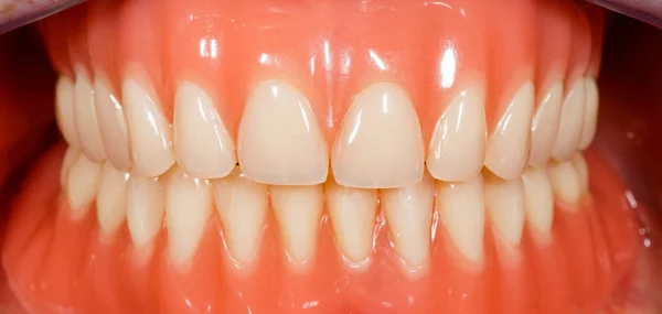 Dentaduras acrílicas removíveis — Fotografia de Stock