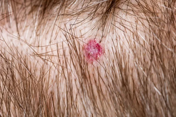 Nevus on human scalp — Stock Photo, Image