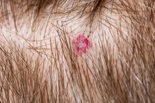 Nevus på människans hårbotten — Stockfoto