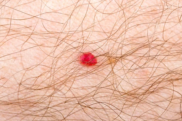 人皮肤上的樱桃血管瘤 图库图片