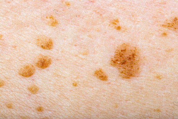 Many nevus on human skin