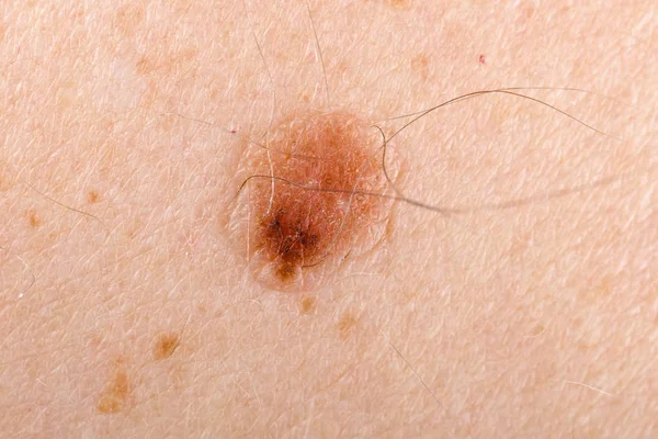 Nevus en la piel humana — Foto de Stock