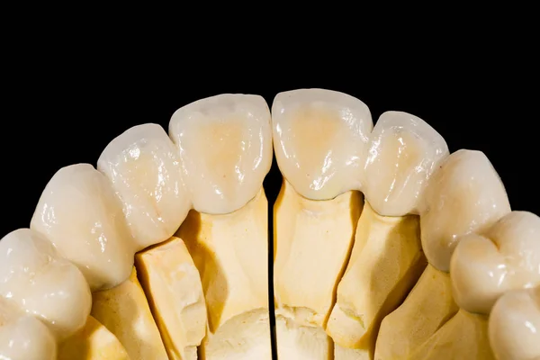 Dentystycznych most ceramiczny — Zdjęcie stockowe