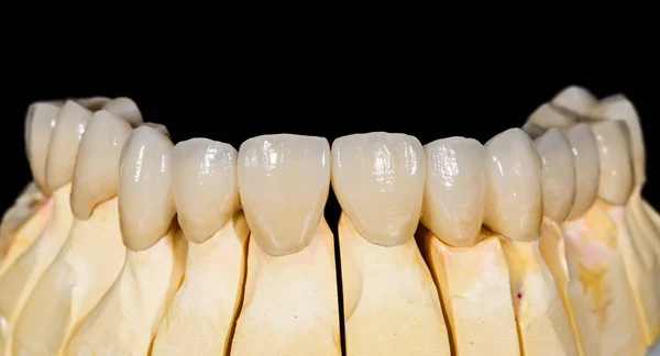 歯科用セラミックのブリッジ — ストック写真