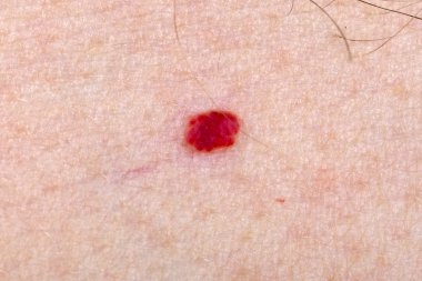 Cherry angioma on human skin clipart