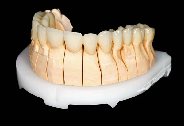 Dentální keramické most — Stock fotografie