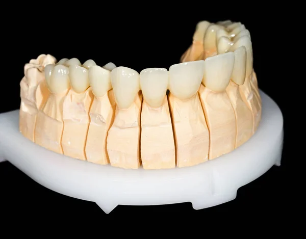 Dental ceramic bridge — Stock Photo, Image