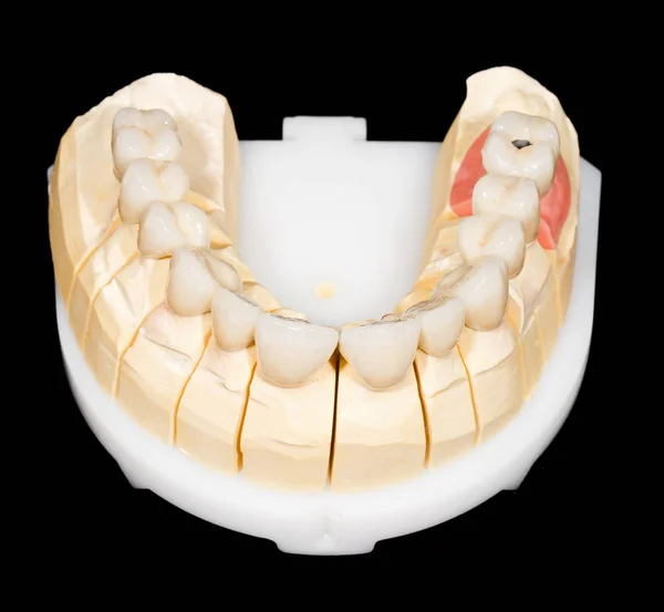 Цирконій стоматологічна мосту — стокове фото