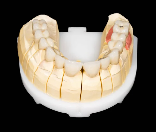 Dental zirconia bro — Stockfoto