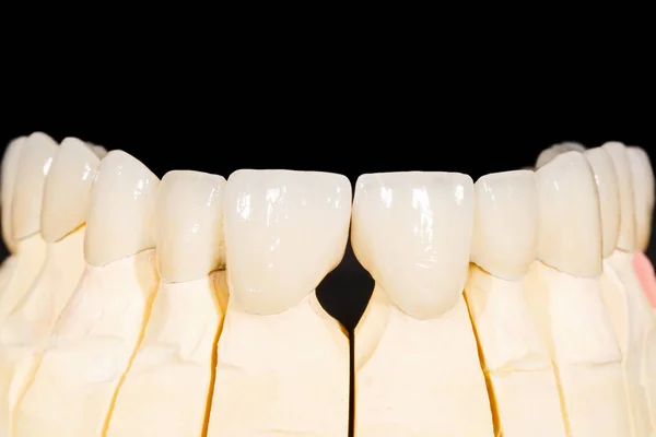 Puente de zirconia dental —  Fotos de Stock