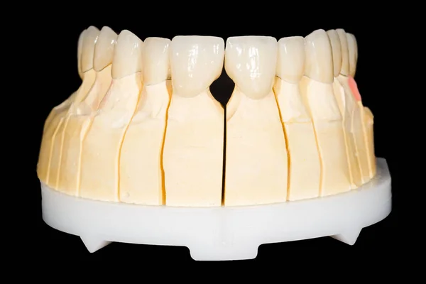 Puente de zirconia dental — Foto de Stock