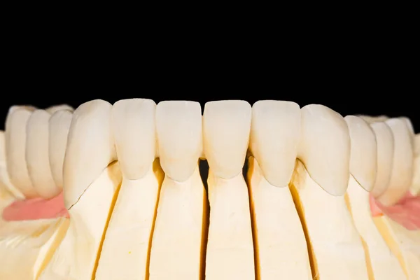 Dental zirconia bridge — Stock Photo, Image