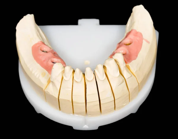 Diş güdük ve implantlar — Stok fotoğraf