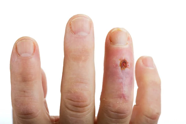 Postoperative Narbe am vierten Finger — Stockfoto