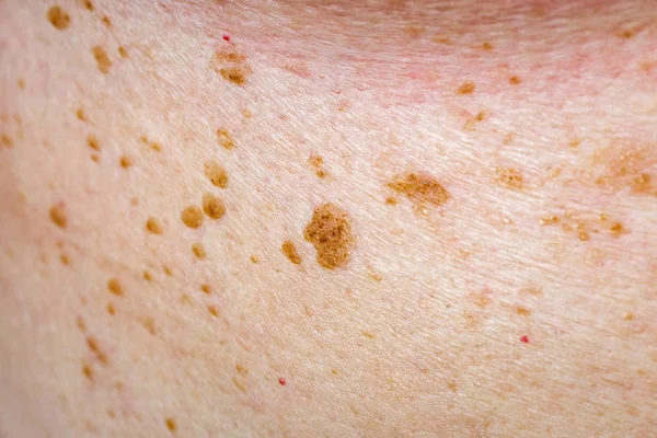 Many nevus on human skin — Stock Photo, Image