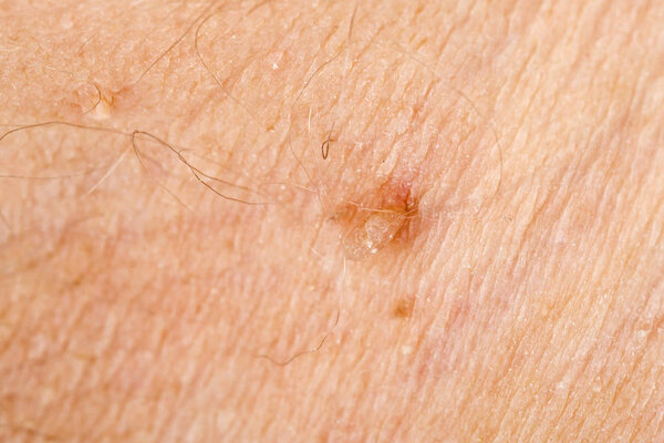 Wart on human skin