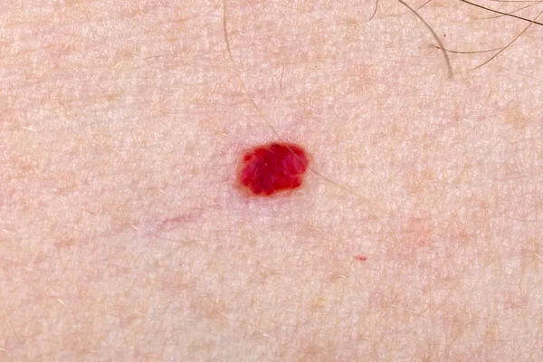 Angioma de cereja na pele humana — Fotografia de Stock