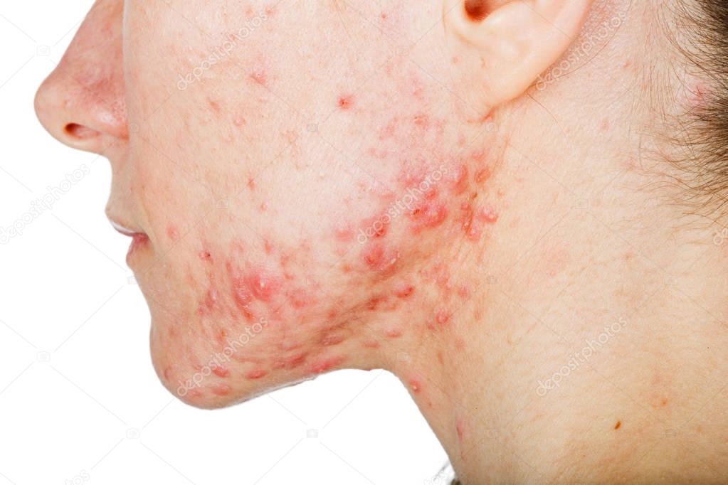  Young girl with skin problem