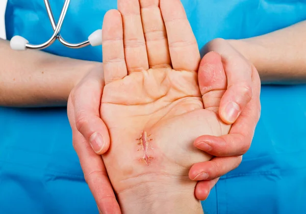 Dokter Onderzoekt Chirurgische Hechting Palm Van Hand — Stockfoto