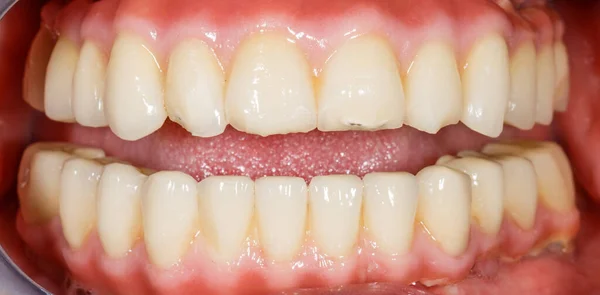 氧化锆牙在人类口中的近照 — 图库照片
