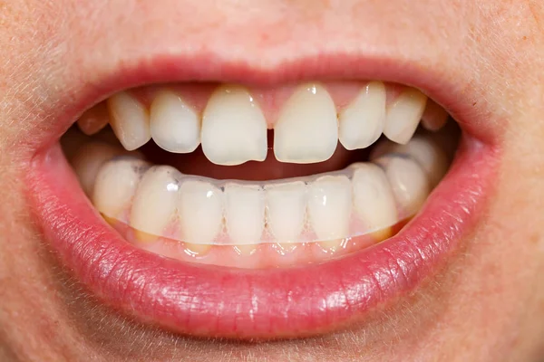 Een Bijtplaat Mond Plaatsen Tanden Nachts Beschermen Tegen Slijpen Veroorzaakt — Stockfoto