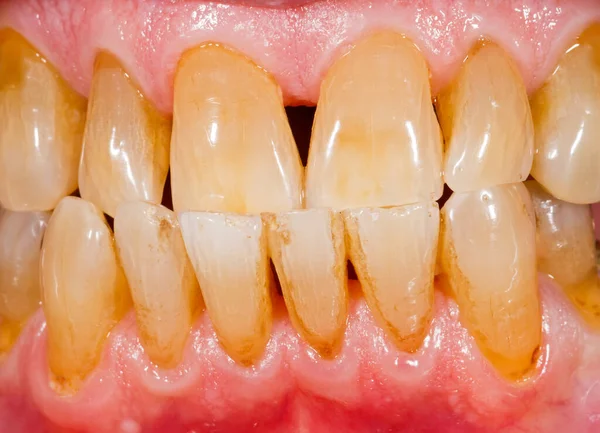氧化锆牙在人类口中的近照 免版税图库照片