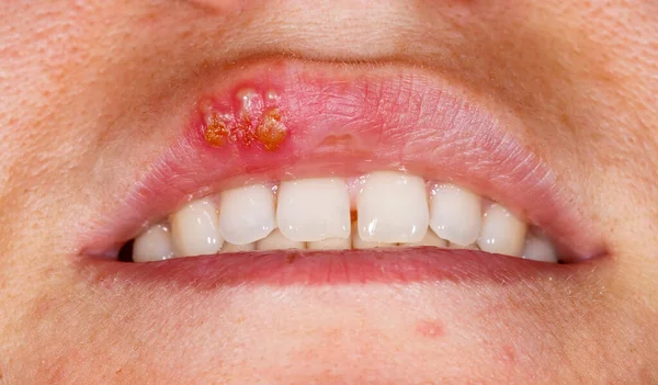 Close Foto Infecção Por Vírus Herpes Simplex Oral — Fotografia de Stock