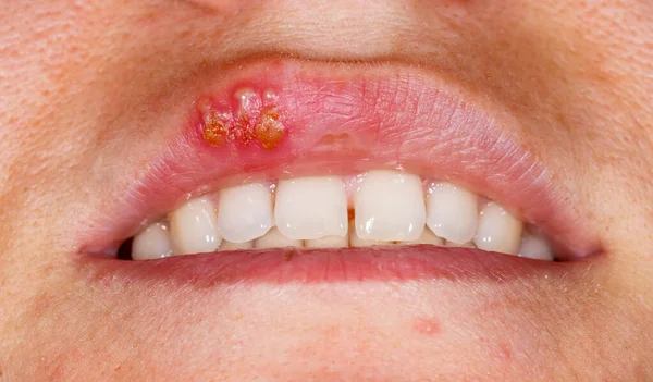 Close Foto Infecção Por Vírus Herpes Simplex Oral Fotografia De Stock