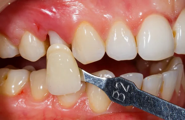 牙科诊所确定牙齿颜色的照片 — 图库照片