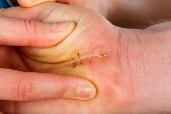 Succès Guéri Suture Chirurgicale Sur Paume Main Après Opération — Photo