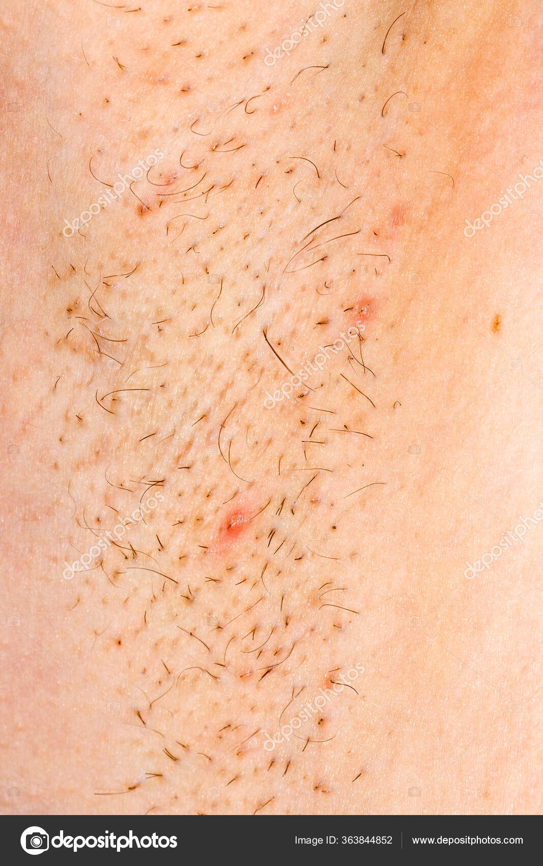 Premium Vector  Ingrown hair hair has grown back into the skin surface  after shaving