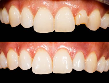 Close up photo of teeth before and after treatment clipart