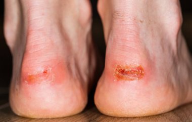 Topuğundaki ağrılı yaranın yakın fotoğrafını çek.