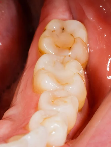 Foto Cerca Los Dientes Humanos Antes Del Tratamiento Dental —  Fotos de Stock