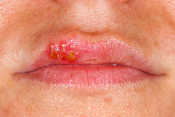 Close up photo of oral herpes simplex virus infection