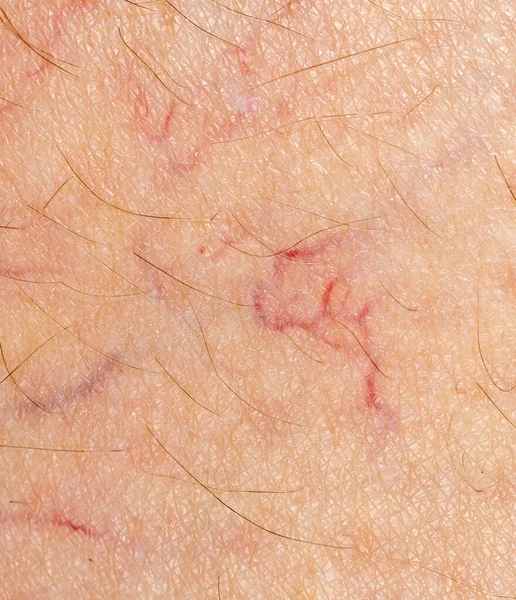 Nahaufnahme Von Besenreiser Erweiterten Blutgefäßen Der Menschlichen Haut Stockbild