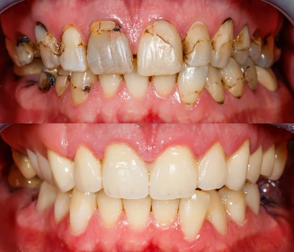 Fechar Foto Dos Dentes Antes Depois Tratamento — Fotografia de Stock