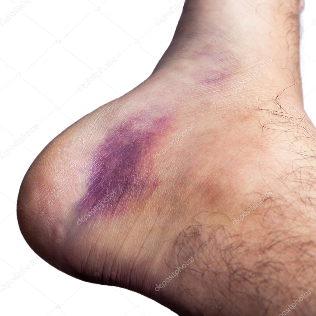 Bruised ankle after tripping over and twisting